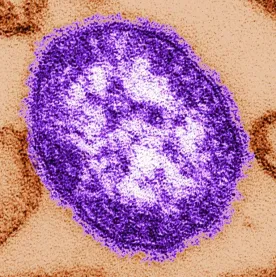 New Brunswick measles outbreak now reporting 44 cases, mostly teens and children